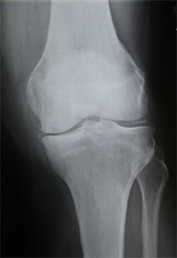 Beispiel einer Kniegelenksarthrose